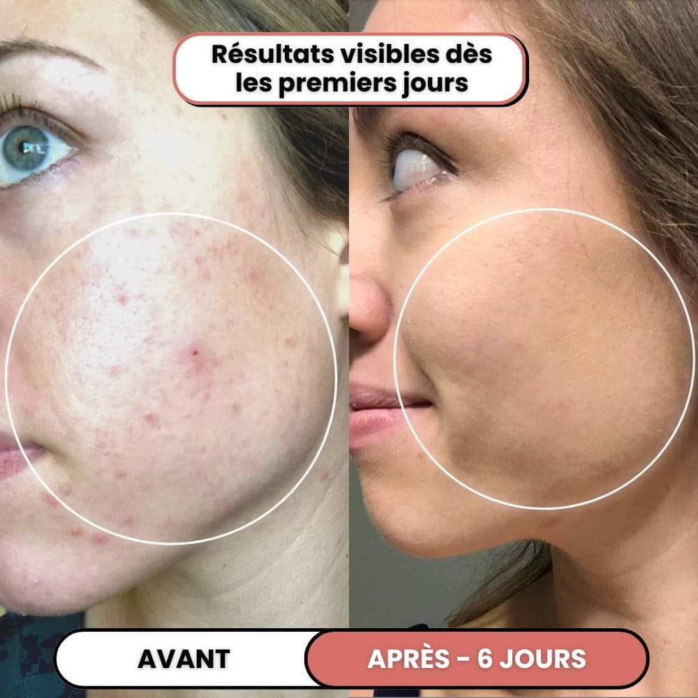 Lusvela | Soin Haute Fréquence 2.0®
