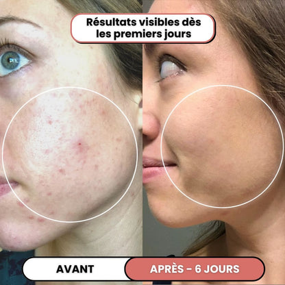 Lusvela | Soin Haute Fréquence 2.0®