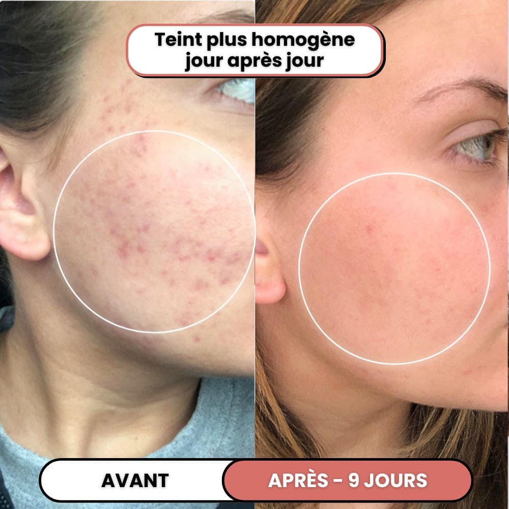 Lusvela | Soin Haute Fréquence 2.0®