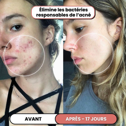 Lusvela | Soin Haute Fréquence 2.0®