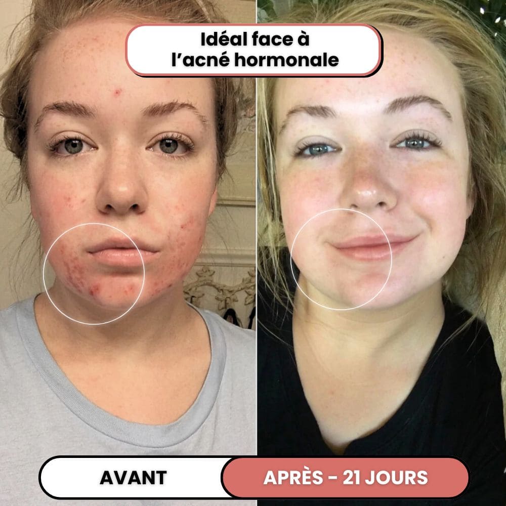 Lusvela | Soin Haute Fréquence 2.0®